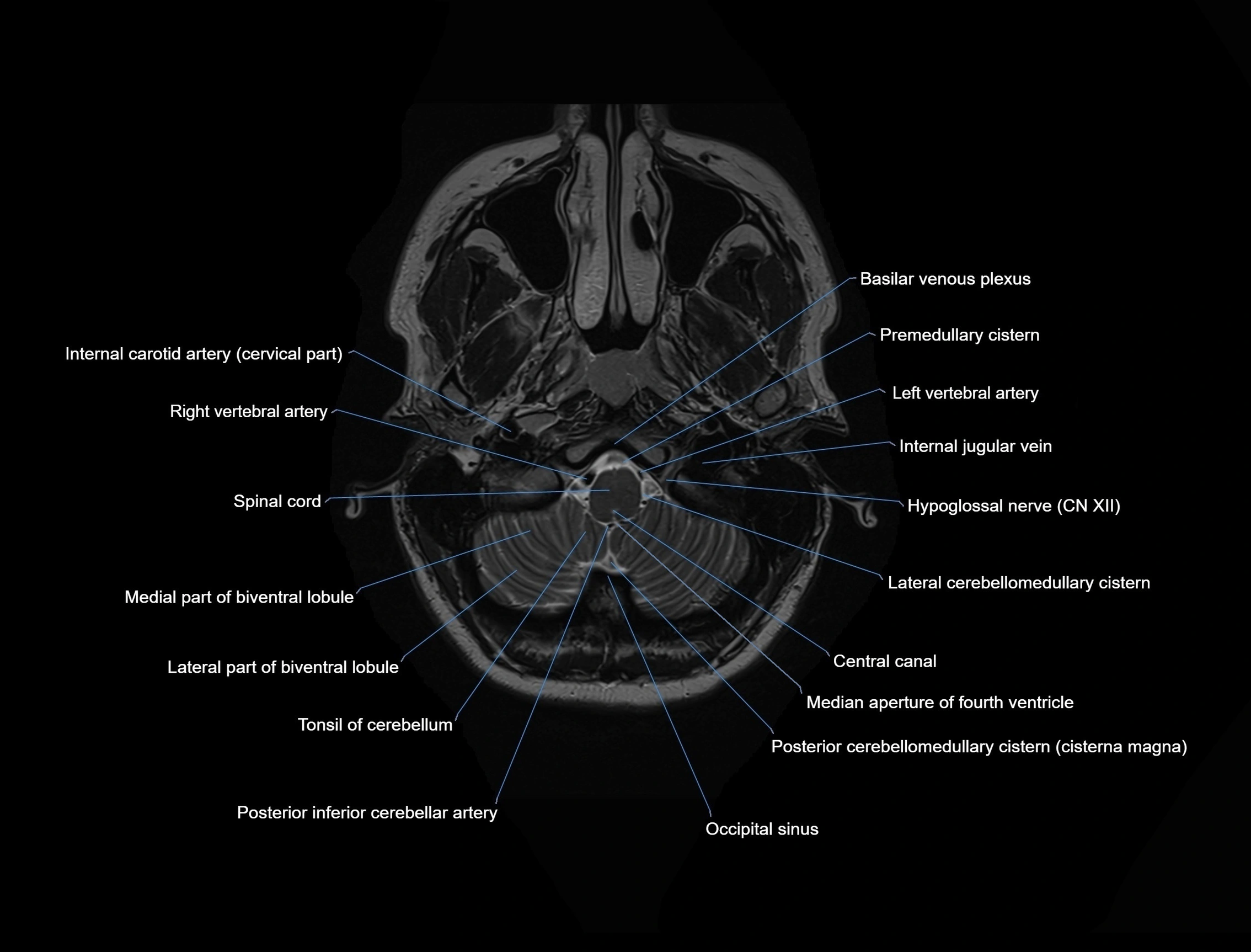 MRI Brain axial cross sectional radiology anatomy 3T image  -img-00001-00005.webp